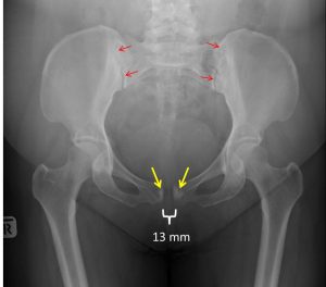 Symphysis pubis diastasis – Radiology Cases