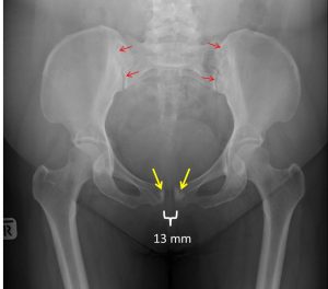 pubic symphysis