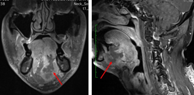 Adenoid Cystic Carcinoma Of Salivary Gland Sublingual Radiology Cases