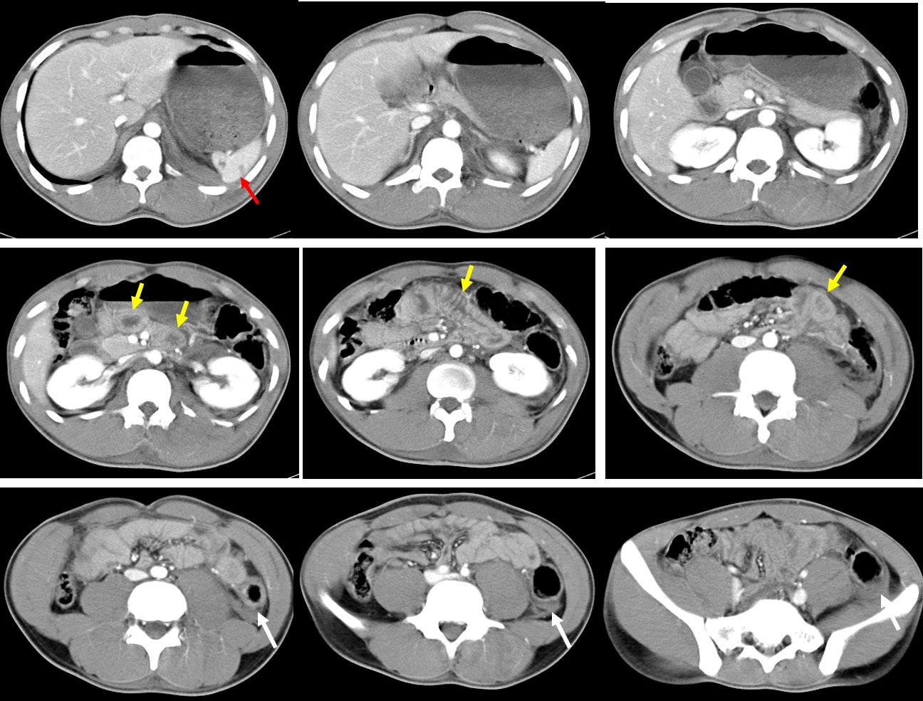 Blunt Abdominal Trauma With Bowel Injuries – Radiology Cases