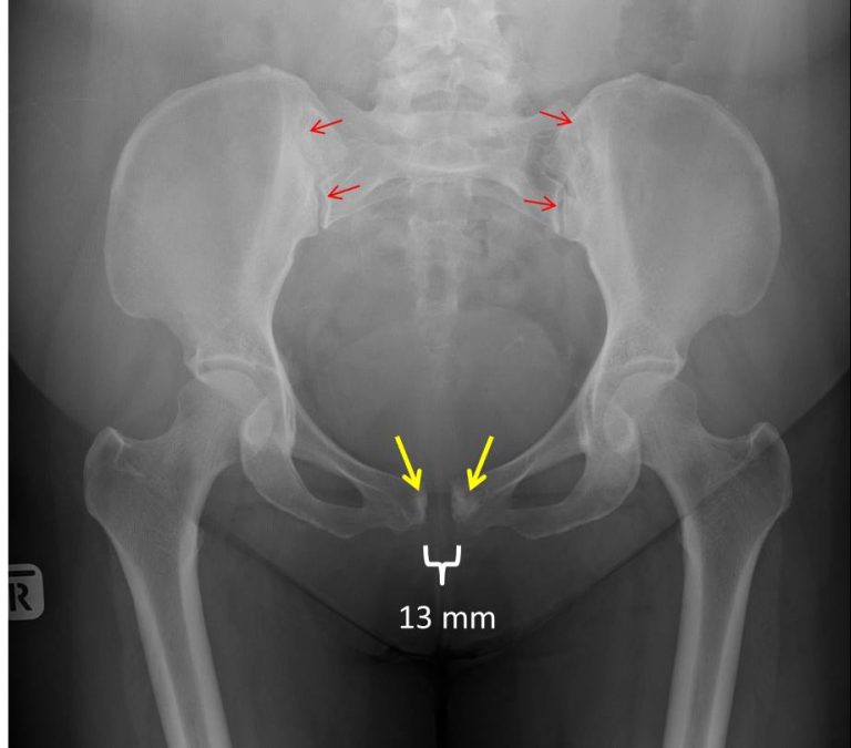 symphysis-pubis-diastasis-radiology-cases