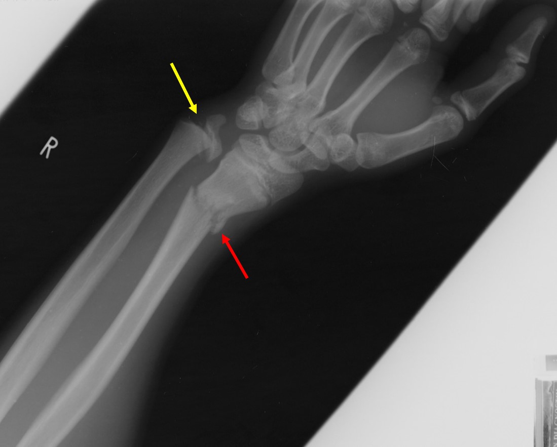 SalterHarris fracture Type I Radiology Cases