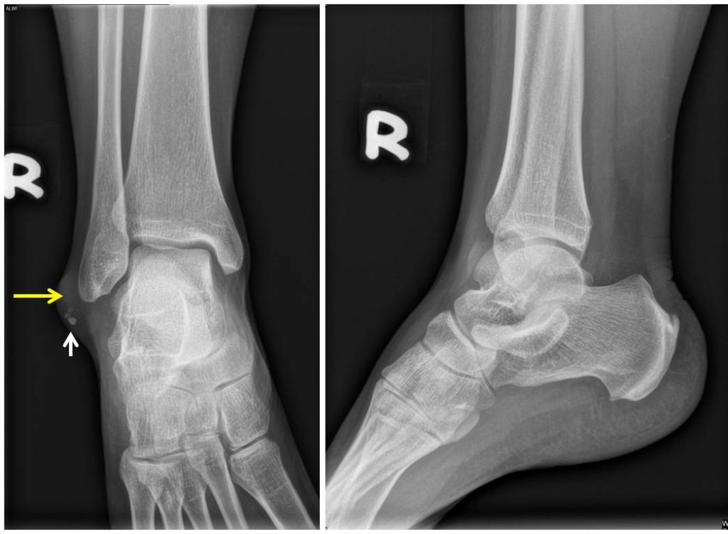 Epidermal cyst at ankle Radiology Cases