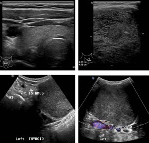 thyroglossal duct cyst ultrasound