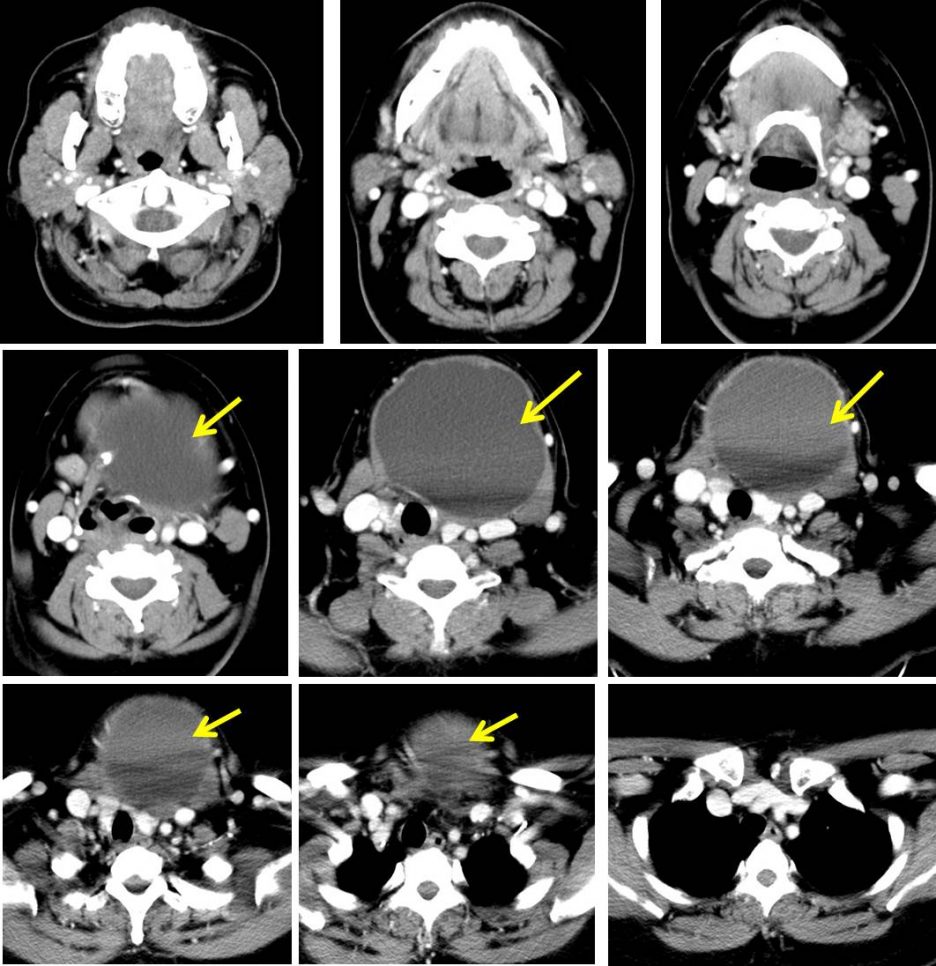 Thyroglossal Duct Cyst – Radiology Cases