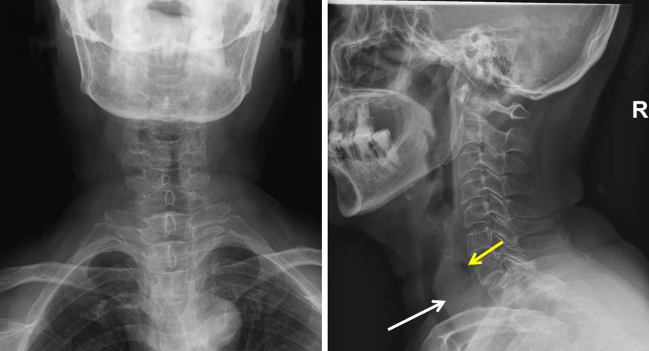 Metastatic Papillary Thyroid Carcinoma Radiology Cases