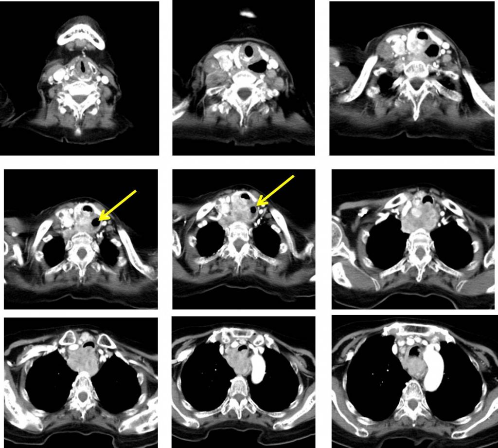 Metastatic Papillary Thyroid Carcinoma – Radiology Cases