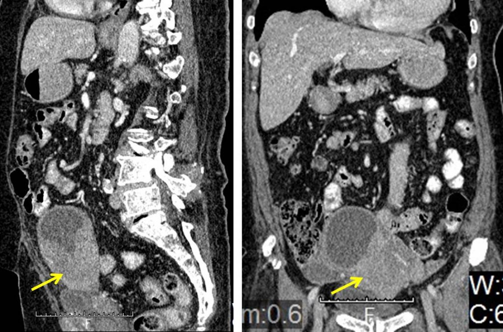 Endometrioid Carcinoma Of Uterine Corpus – Radiology Cases