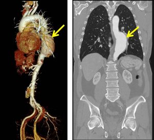 thoracic aortic aneurysm xray