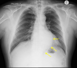 thoracic aortic aneurysm xray