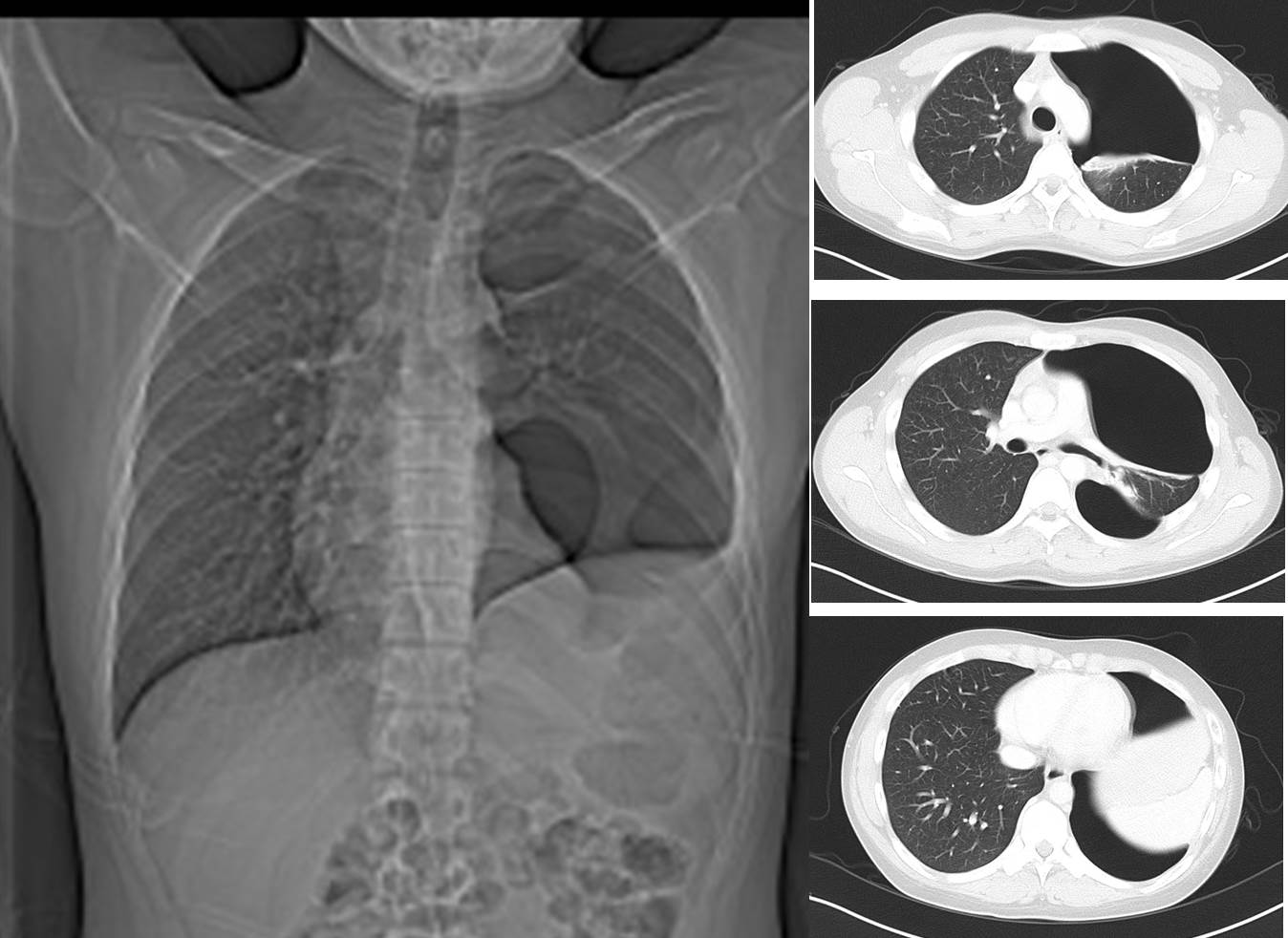 Pleural Based Mass Radiology Cases