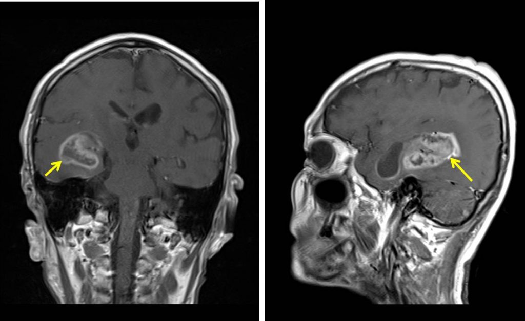 Glioblastoma Multiforme Radiology Cases 5678