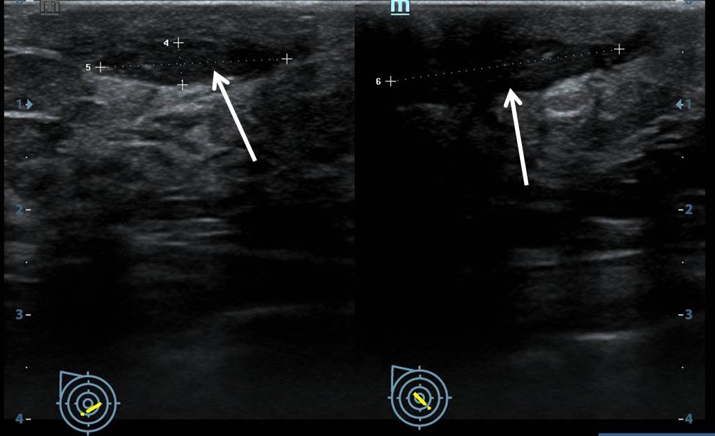 Granulomatous mastitis Radiology Cases