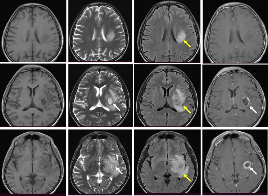 brain abscess non contrast ct