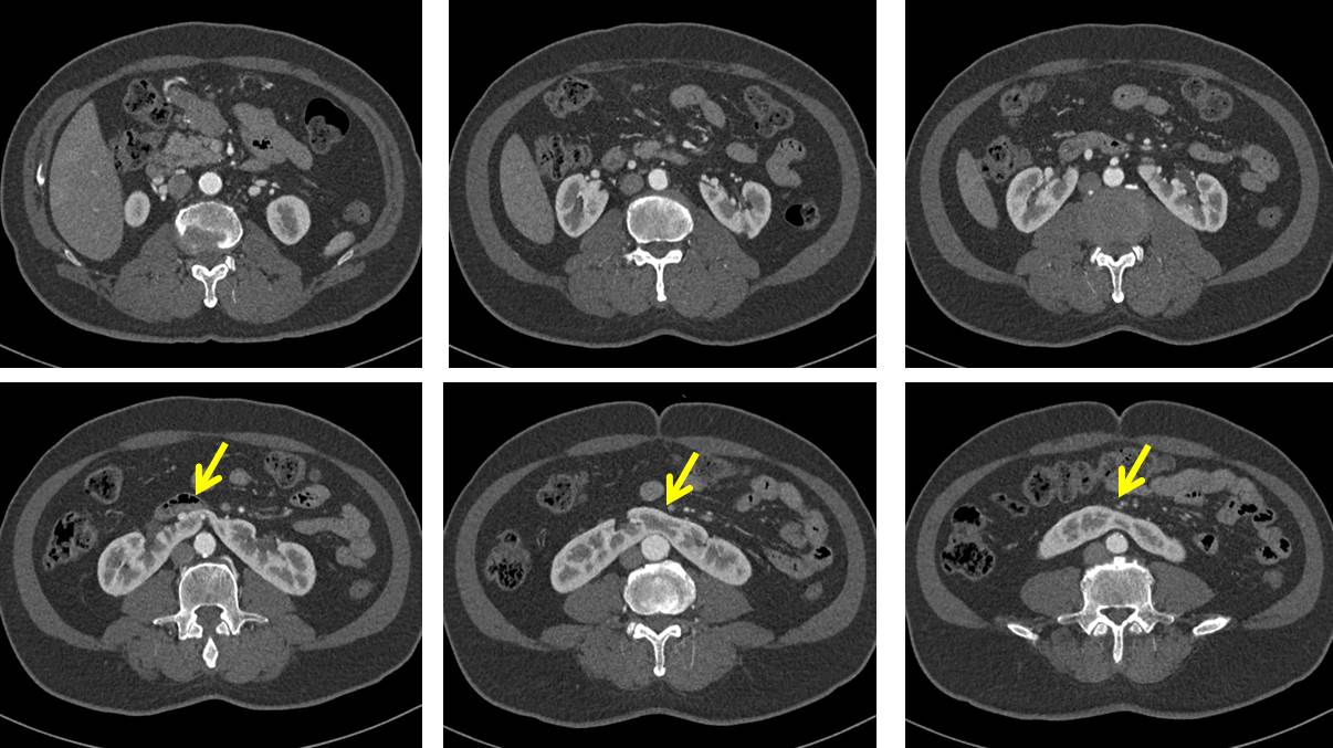 Horseshoe Kidney Radiology Cases