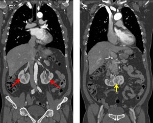 Horseshoe kidney, Radiology Reference Article