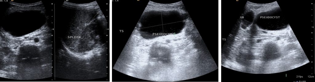 pancreatic pseudocyst ultrasound