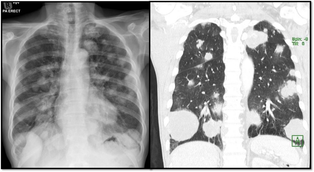 Cannonballs lung metastases Radiology Cases