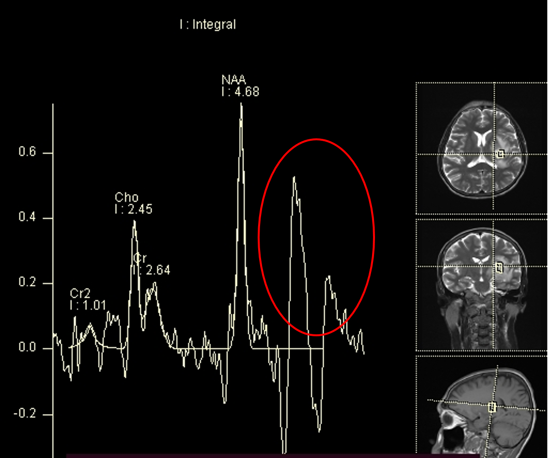 Cerebral Abscess – Radiology Cases