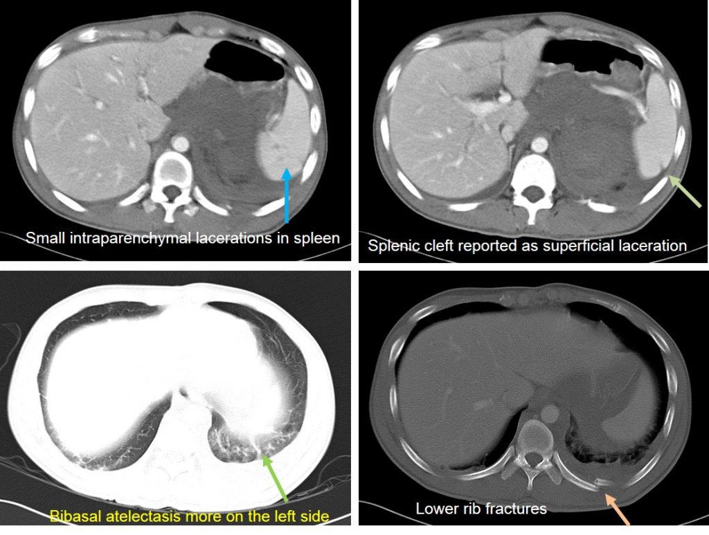 Shattered Kidney With Active Bleed Radiology Cases