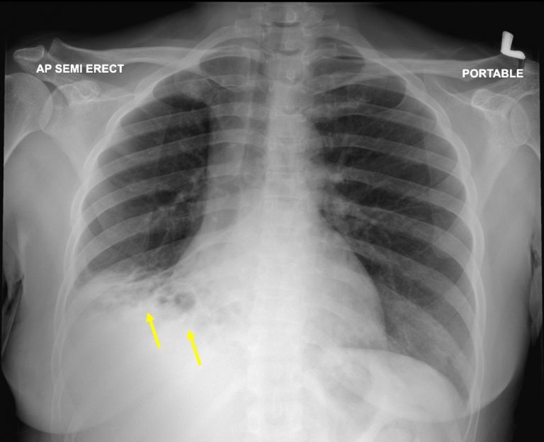 Foreign body induced bronchiectasis Radiology Cases