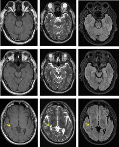 medial geniculate nucleus mri