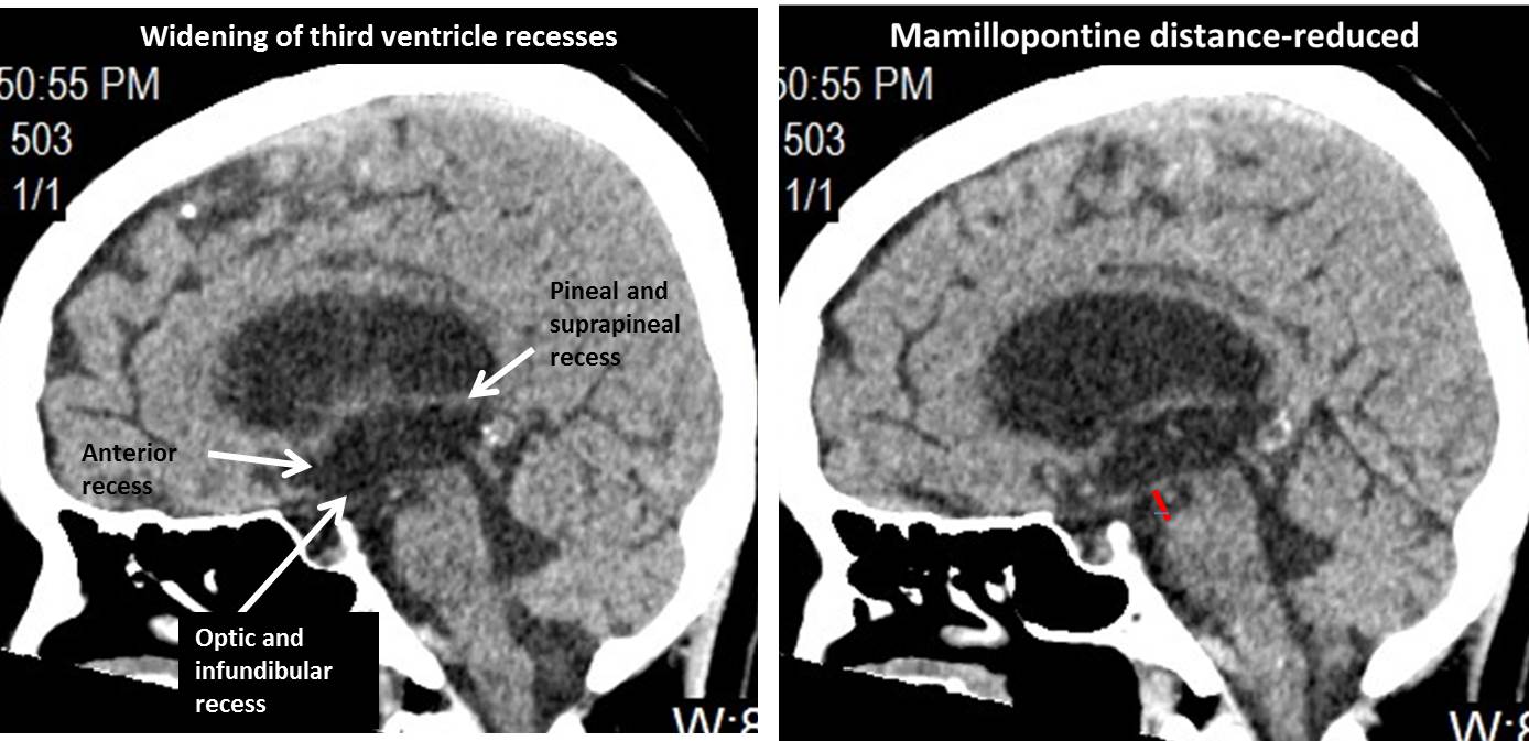 Normal Pressure Hydrocephalus Radiology Cases 8200