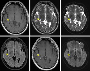 medial geniculate nucleus mri