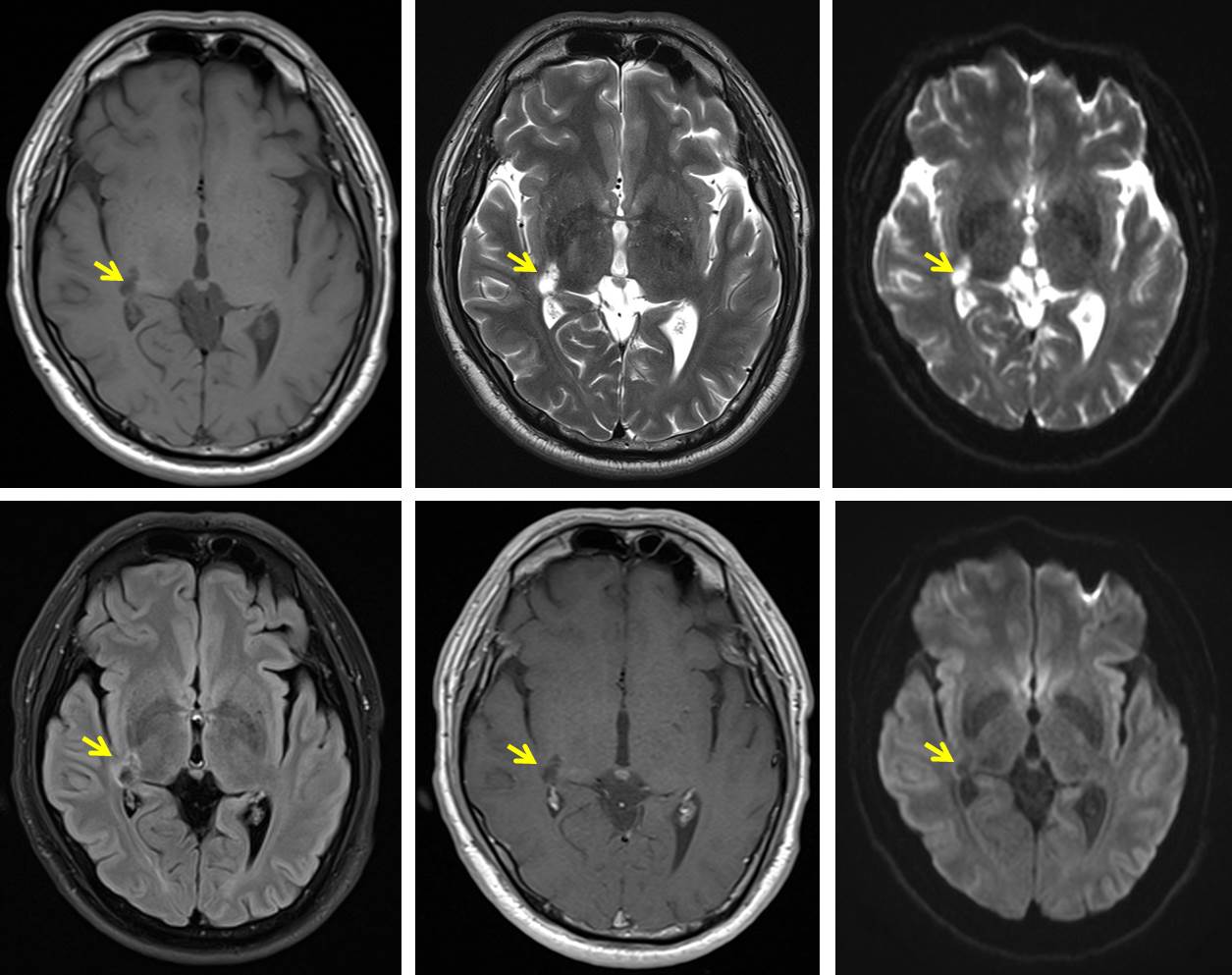 lateral-geniculate-body-infarction-radiology-cases