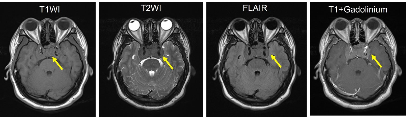 Recurrent Non Functioning Pituitary Adenoma Radiology Cases