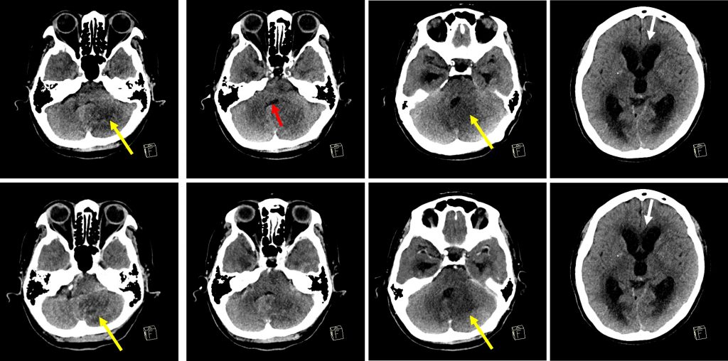 PICA infarct, Radiology Case