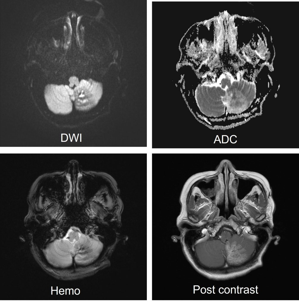 PICA infarct, Radiology Case