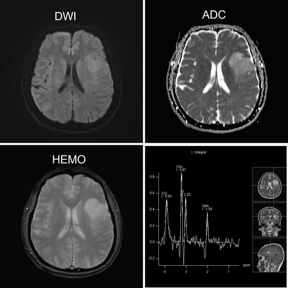 low-grade-glioma-radiology-cases