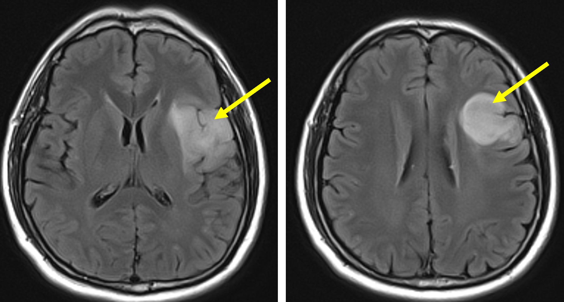 low-grade-glioma-radiology-cases