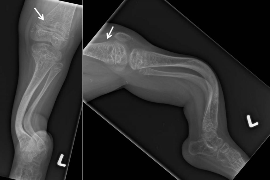 Zebra stripe sign Radiology Cases