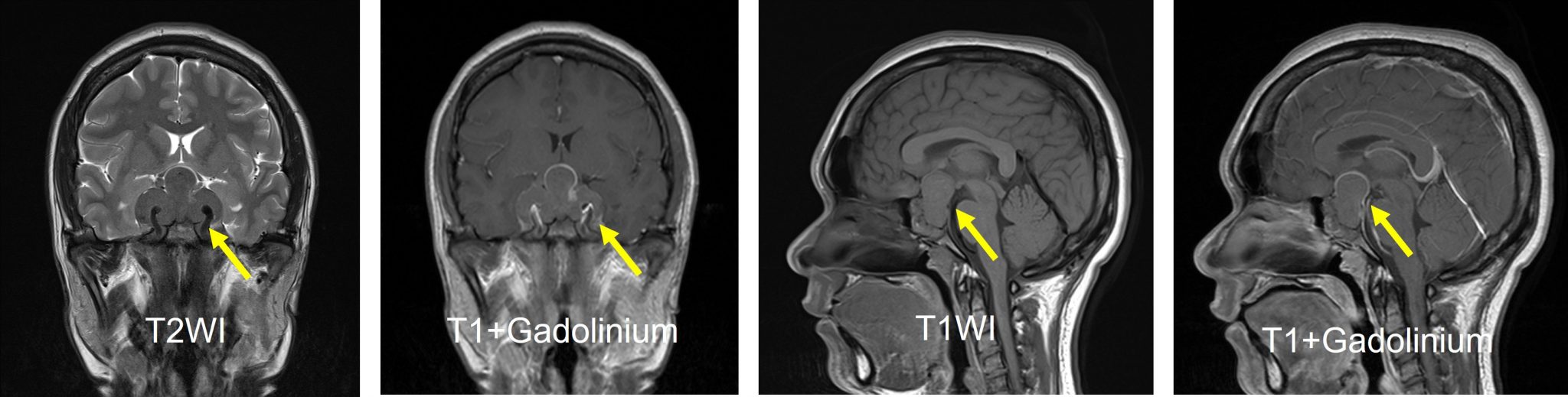 Recurrent Non Functioning Pituitary Adenoma Radiology Cases