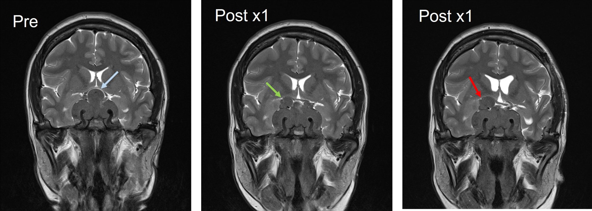 Recurrent Non Functioning Pituitary Adenoma Radiology Cases