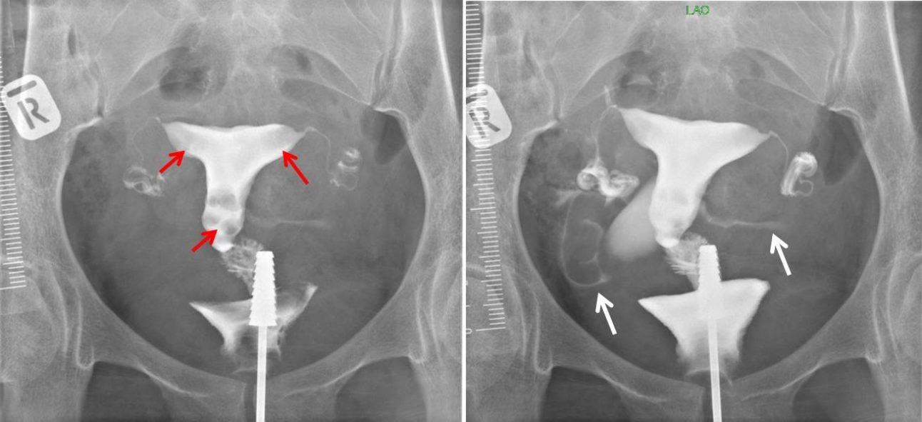 cervical-plicae-palmatae-radiology-cases