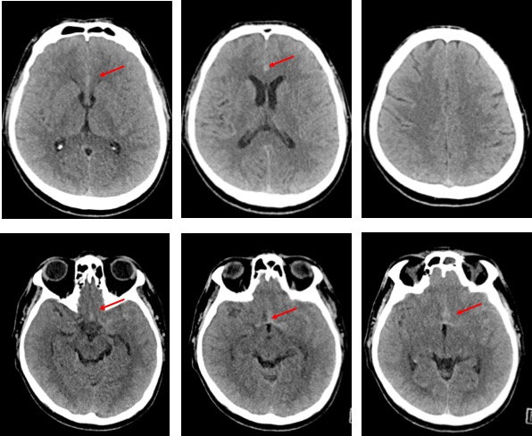 ruptured-acom-aneurysm-radiology-cases