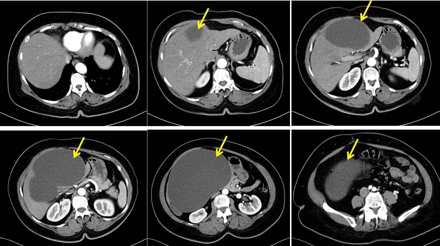 Mucinous cystic neoplasm of the liver Radiology Cases
