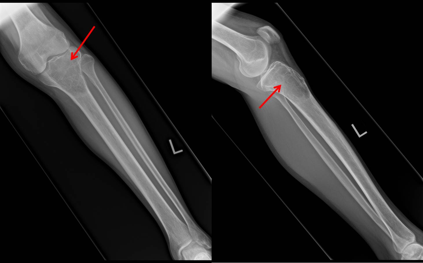 Aneursymal Bone Cyst Radiology Cases