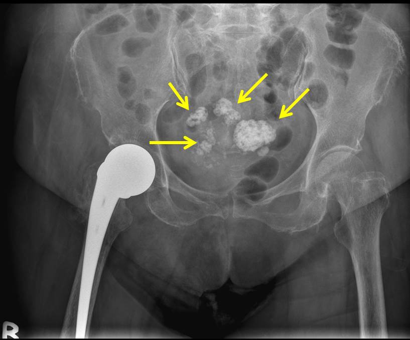 icd 10 code for calcified uterine fibroid
