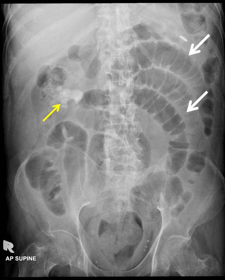 ruptured liver abscess icd 10