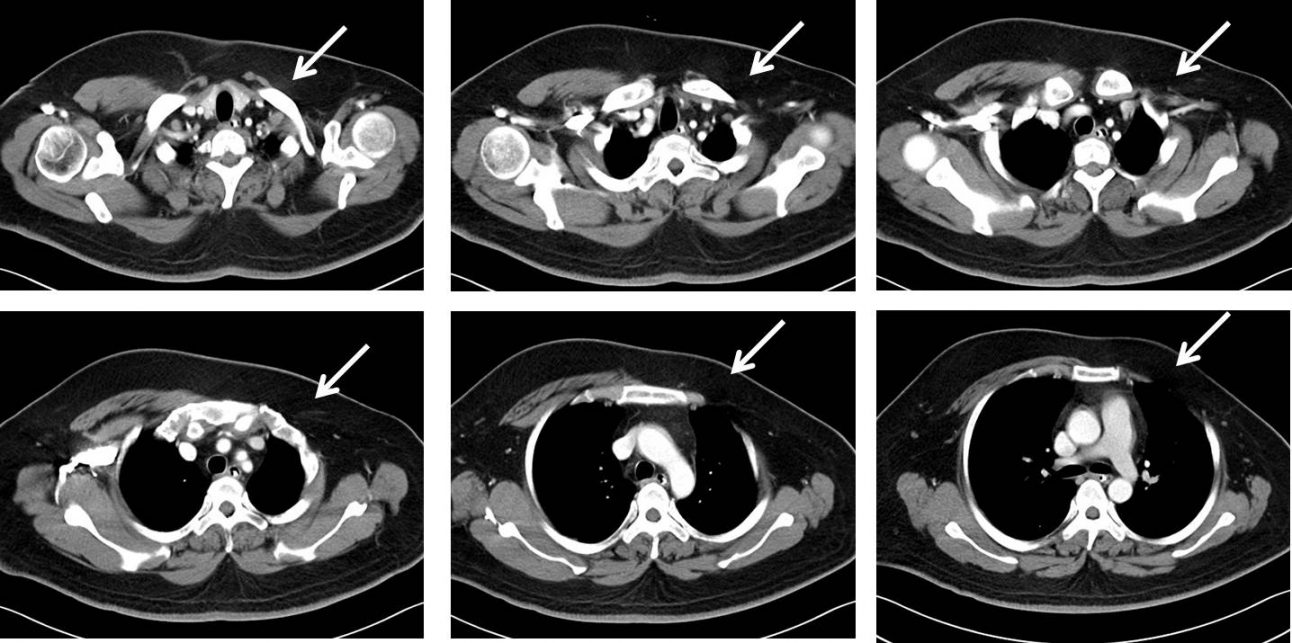 Poland Syndrome Radiology Cases