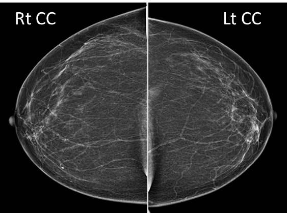Breast Epidermal Cyst Radiology Cases
