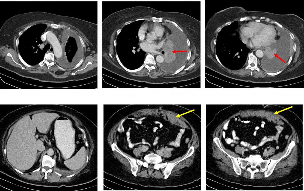 Omental cake from metastatic lung carcinoma Radiology Cases