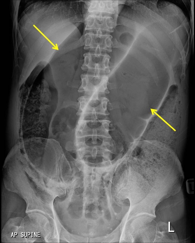 Sigmoid Volvulus Radiology Cases