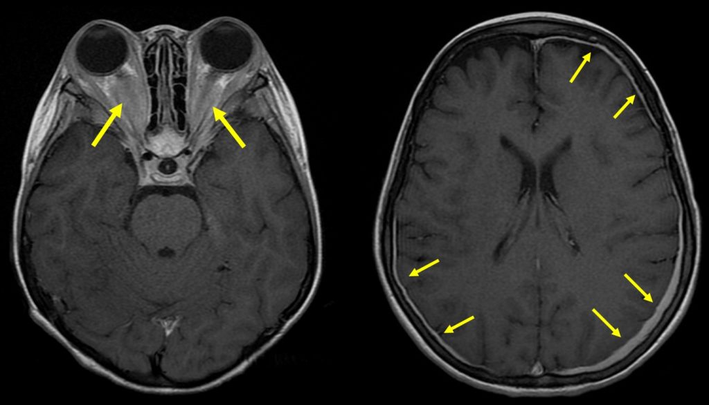 ErdheimChester Disease Radiology Cases