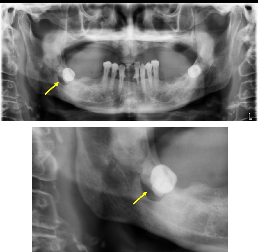 Dentigerous Cyst Radiology Cases