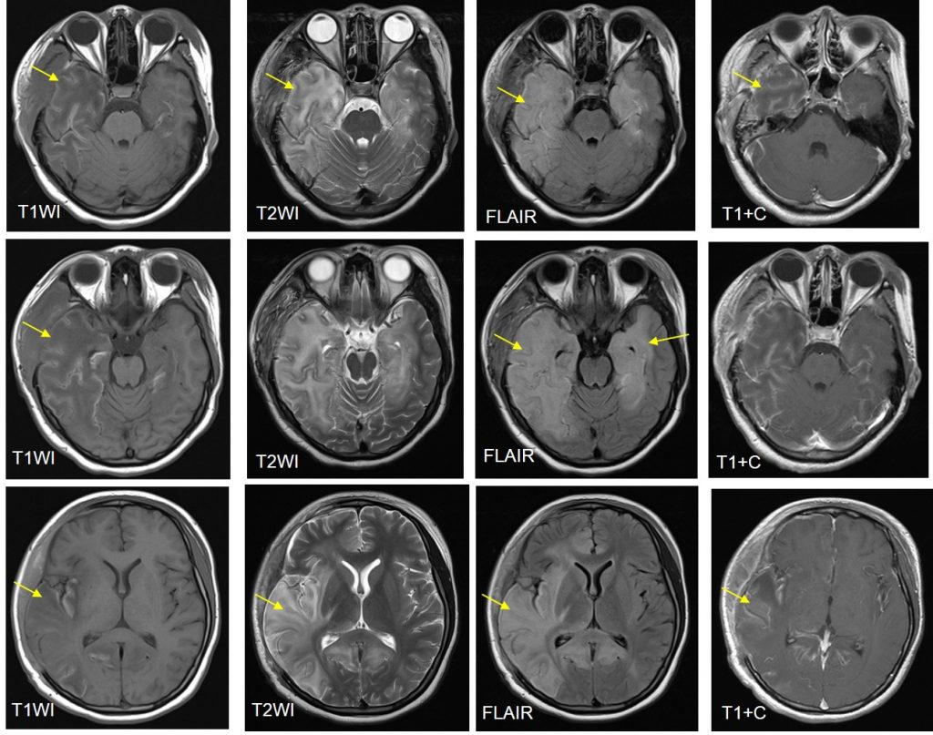 Herpes Encephalitis Herpes Encephalitis